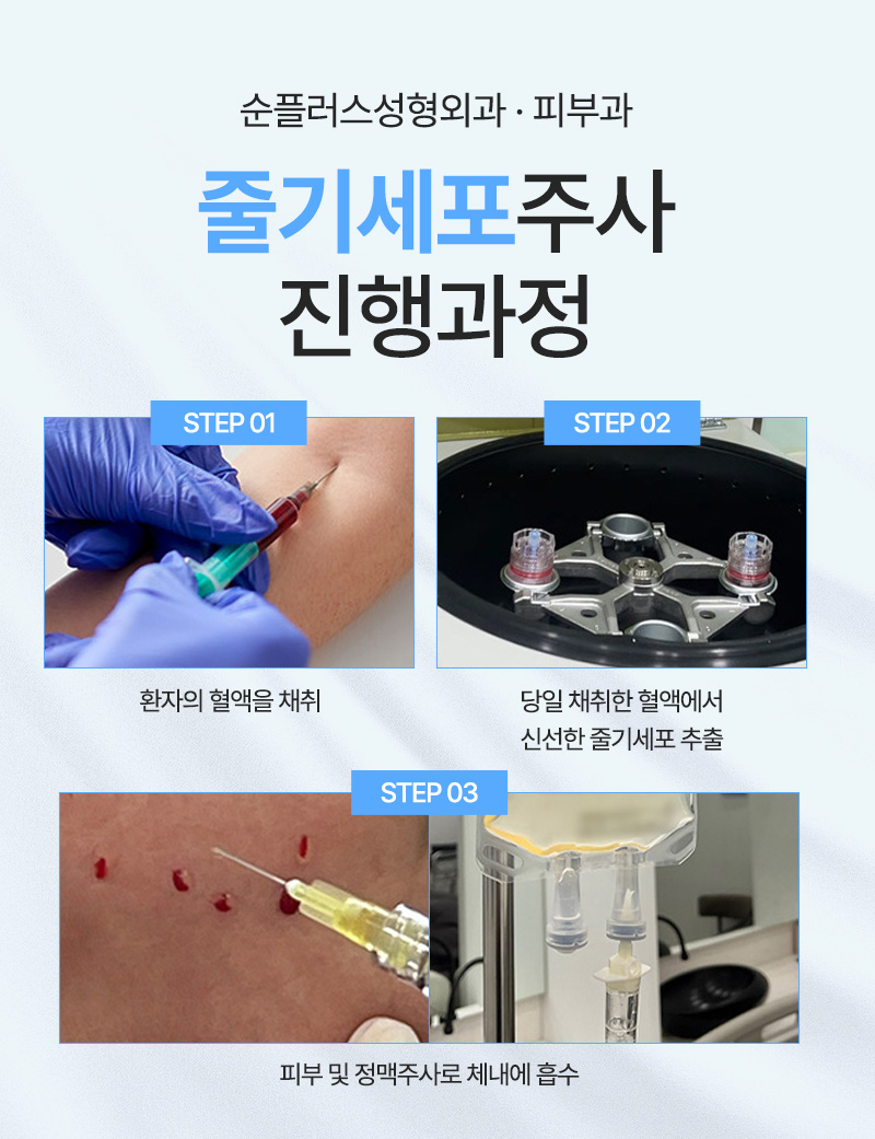 Stem Cell Injection Q&A Complete Guide [Effects by Age Group, Procedure, Same-Day Treatment, Treatment Interval, Duration] image 4