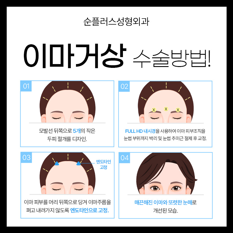 내시경이마거상 어떻게 진행되는지 관련 이미지 5