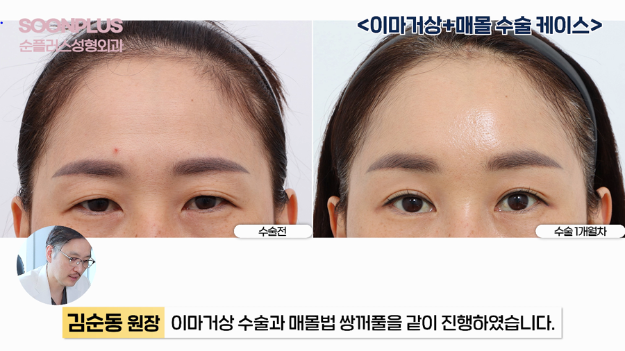 What Surgery Is Performed to Improve Drooping Eyelids and Sagging Eyes, Even by Celebrities? image 10