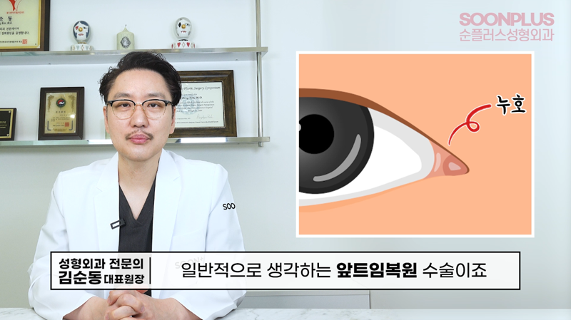 'Am I Really a Candidate for Epicanthoplasty Revision?' Dr. Kim Soondong’s Story About Epicanthoplasty Revision Surgery image 1