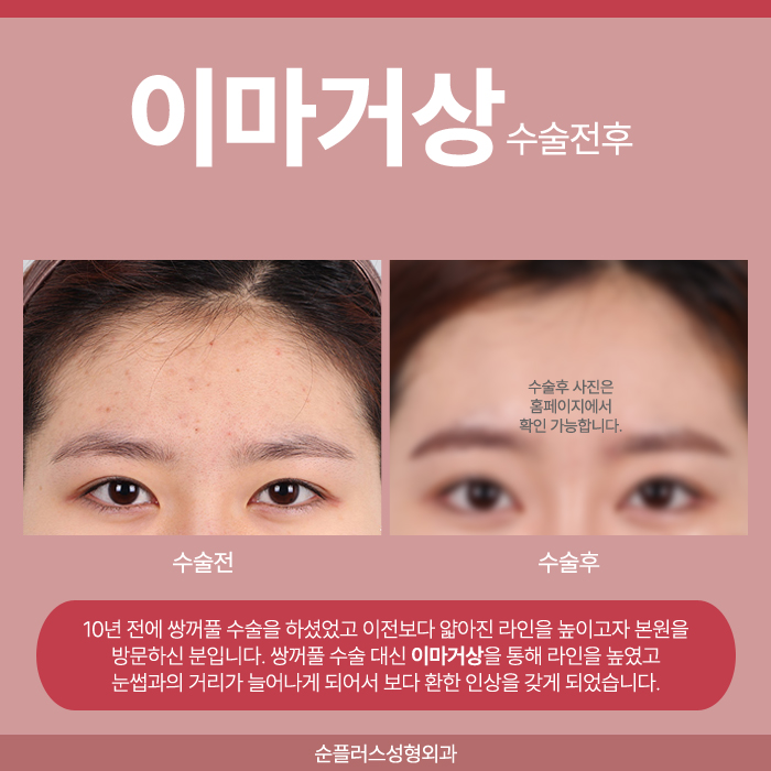 이마주름수술 자연스러운 개선방안을 위해 관련 이미지 6