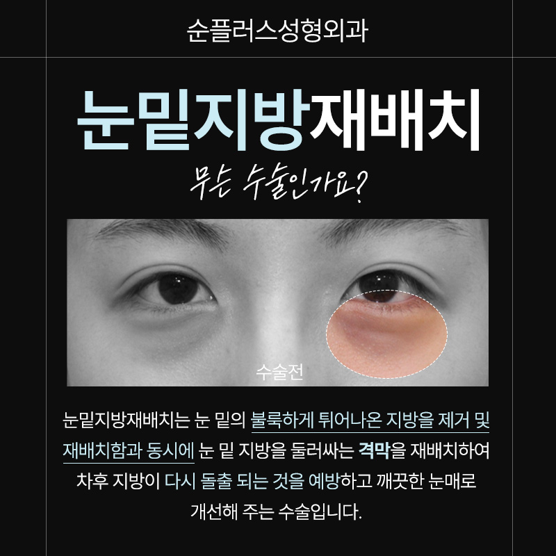 Visiting a Sinsa Station Under-Eye Fat Repositioning Clinic: Detailed Reviews and Reasonable Prices image 2