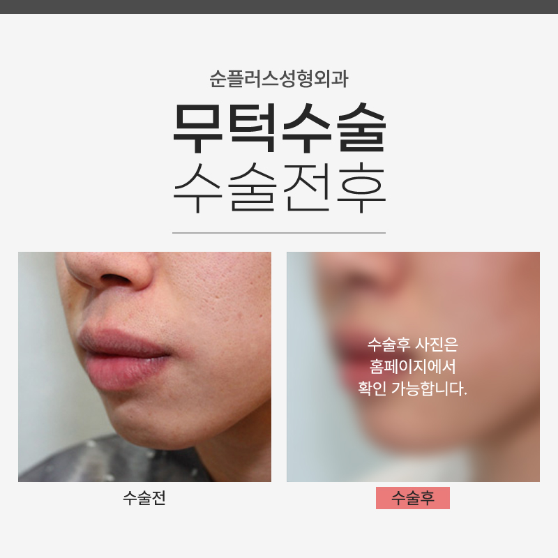 짧은턱 무턱 수술 빠른 회복, 개선 원할때 관련 이미지 7