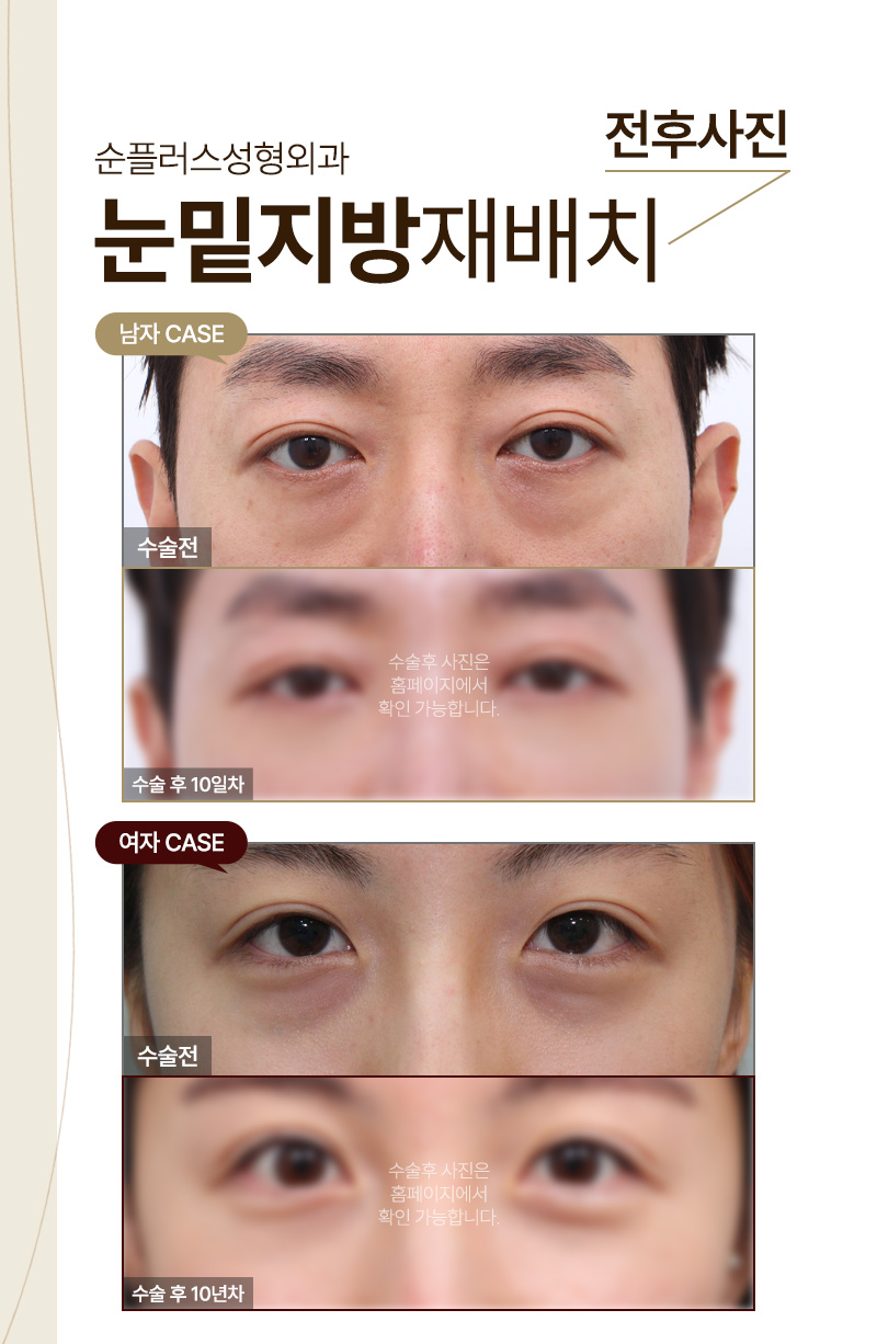 다크써클수술 눈밑지방재배치성형외과 선택은? 관련 이미지 5