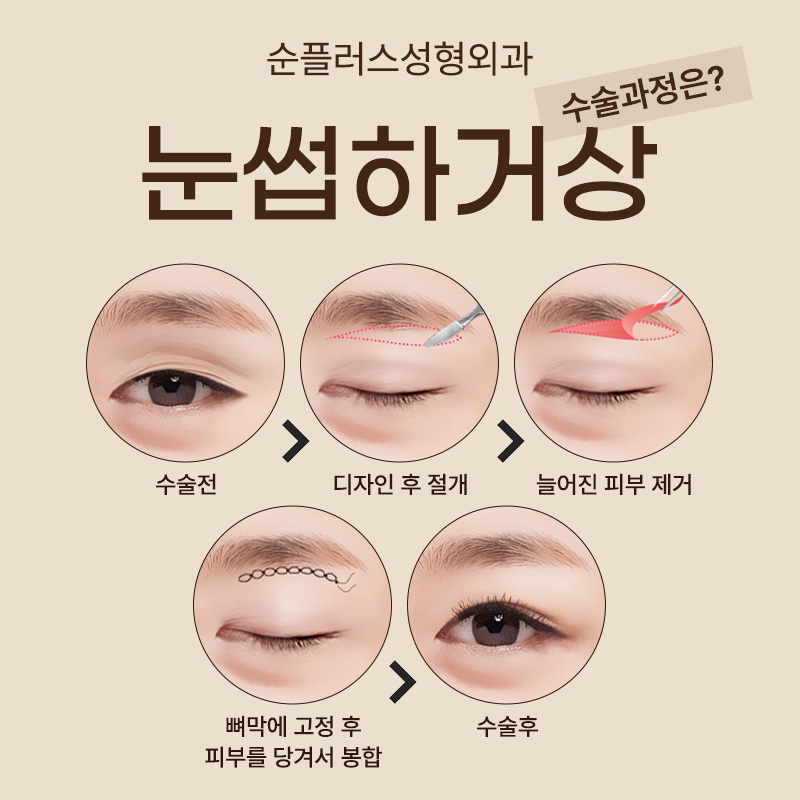 처진눈 자연스럽게 개선하기 위해 눈썹하거상 관련 이미지 4