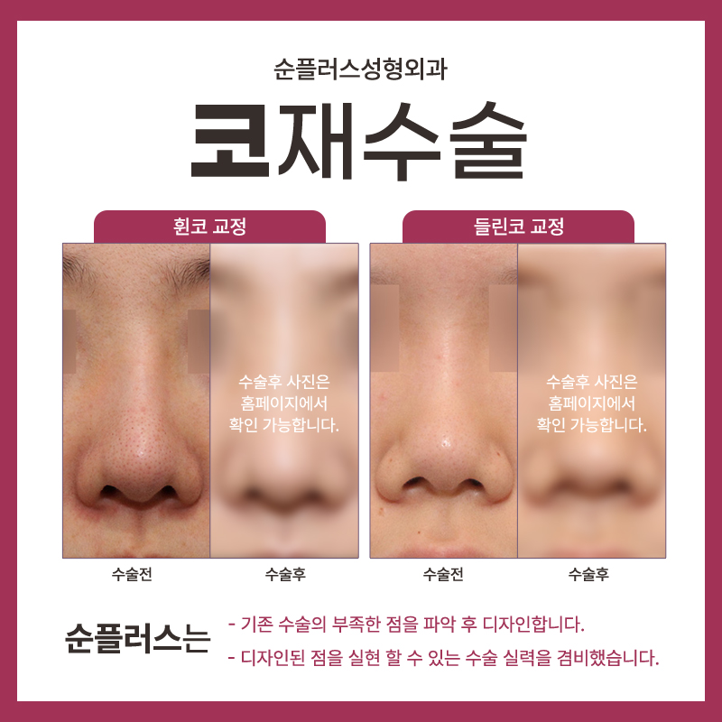 여자코재수술 경험이 많은 곳에서 관련 이미지 3