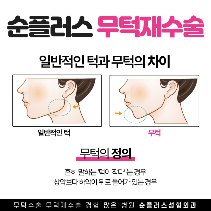 무턱재수술 올바른 위치선정으로 재교정을 관련 이미지 2