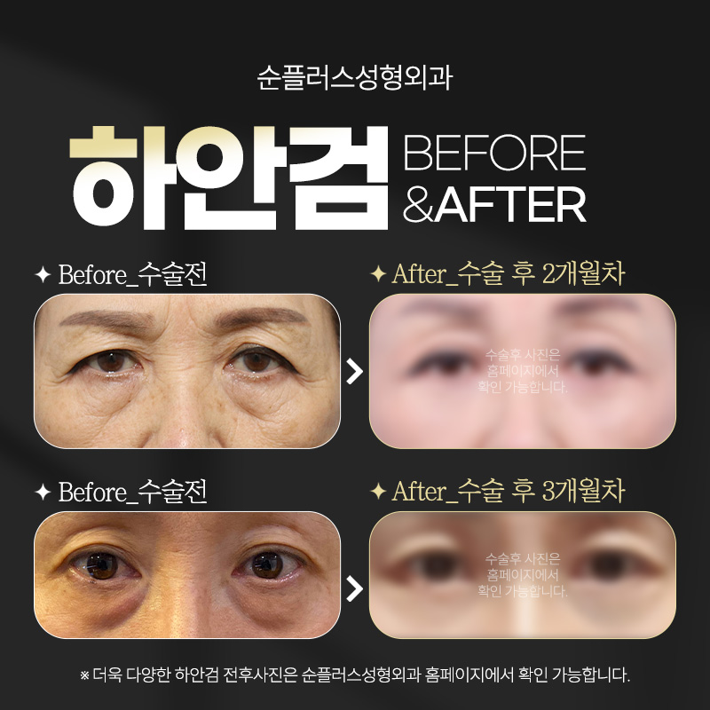 하안검수술 회복기간 흉터 나아지는 시기 관련 이미지 5