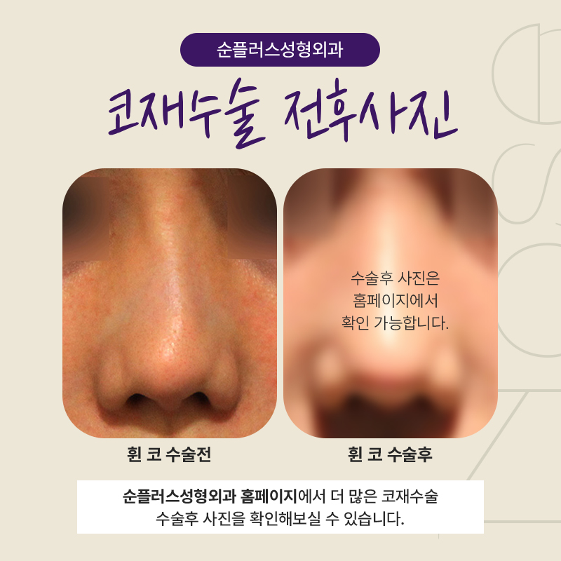 코재수술잘하는곳 신사역에 위치한곳 관련 이미지 5
