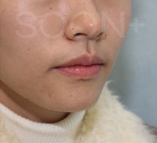 경계가 불분명한 턱끝, 무턱수술 플랜이 필요할때 관련 이미지 8