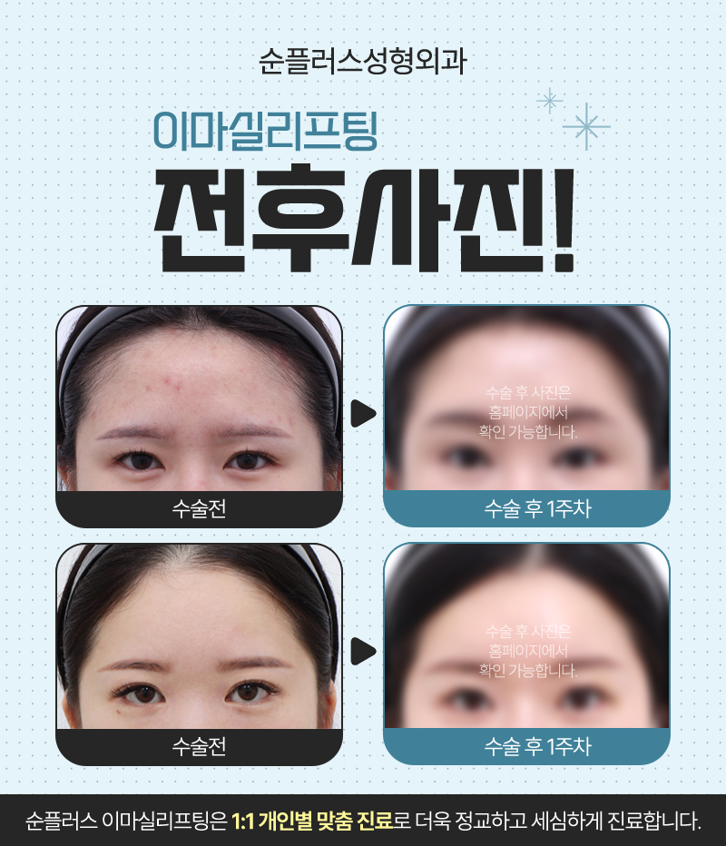 눈썹(이마) 실리프팅, 거슬리는 눈처짐 자연스러운 개선 위해 관련 이미지 3