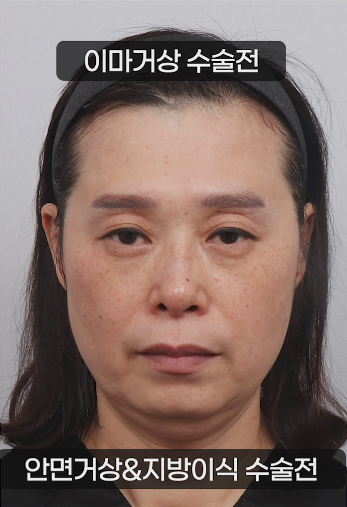 50대 안면거상 이마거상 지방이식으로 동안의 효과를 관련 이미지 1