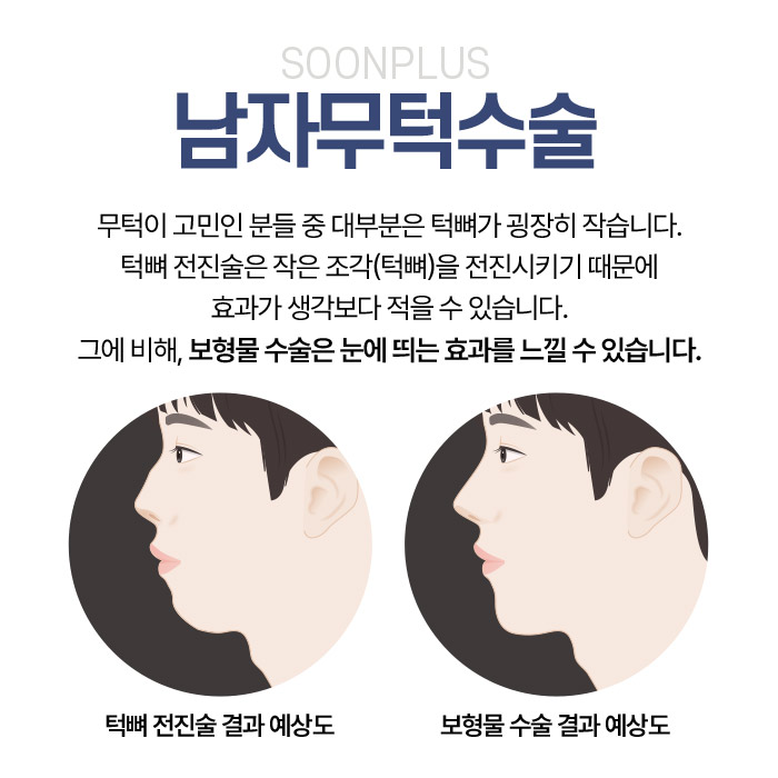 Male Chin-Deficiency Surgery: Even Just the Chin Tip Can Make a Difference image 4