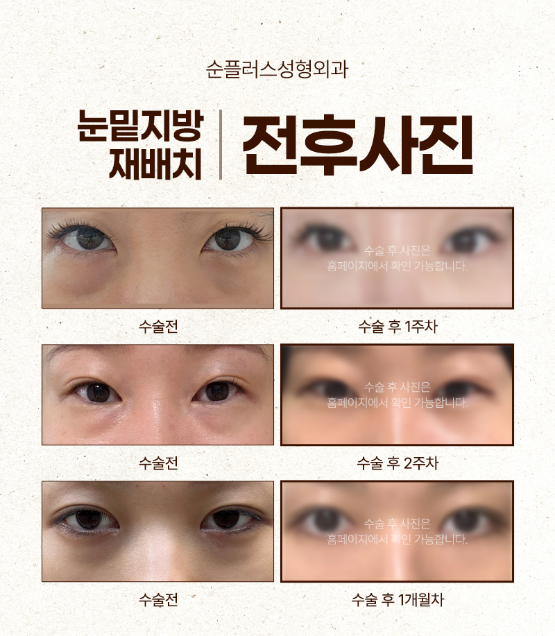 Under-Eye Fat Repositioning: When the Dark Shadow Under the Eyes Is a Concern image 6