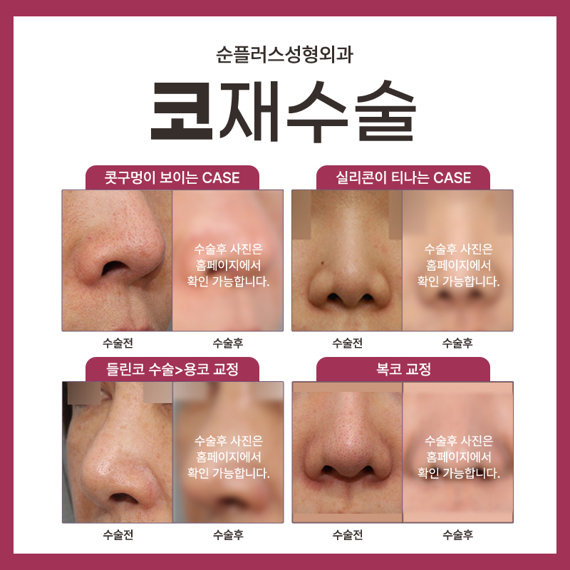 여자코재수술 경험이 많은 곳에서 관련 이미지 5