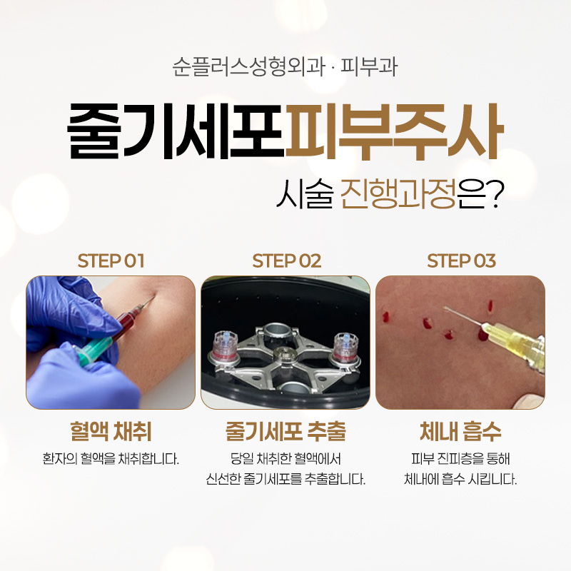 Is There a Procedure That VIP Patients Often Choose? [Stem Cell Skin Injection] image 3