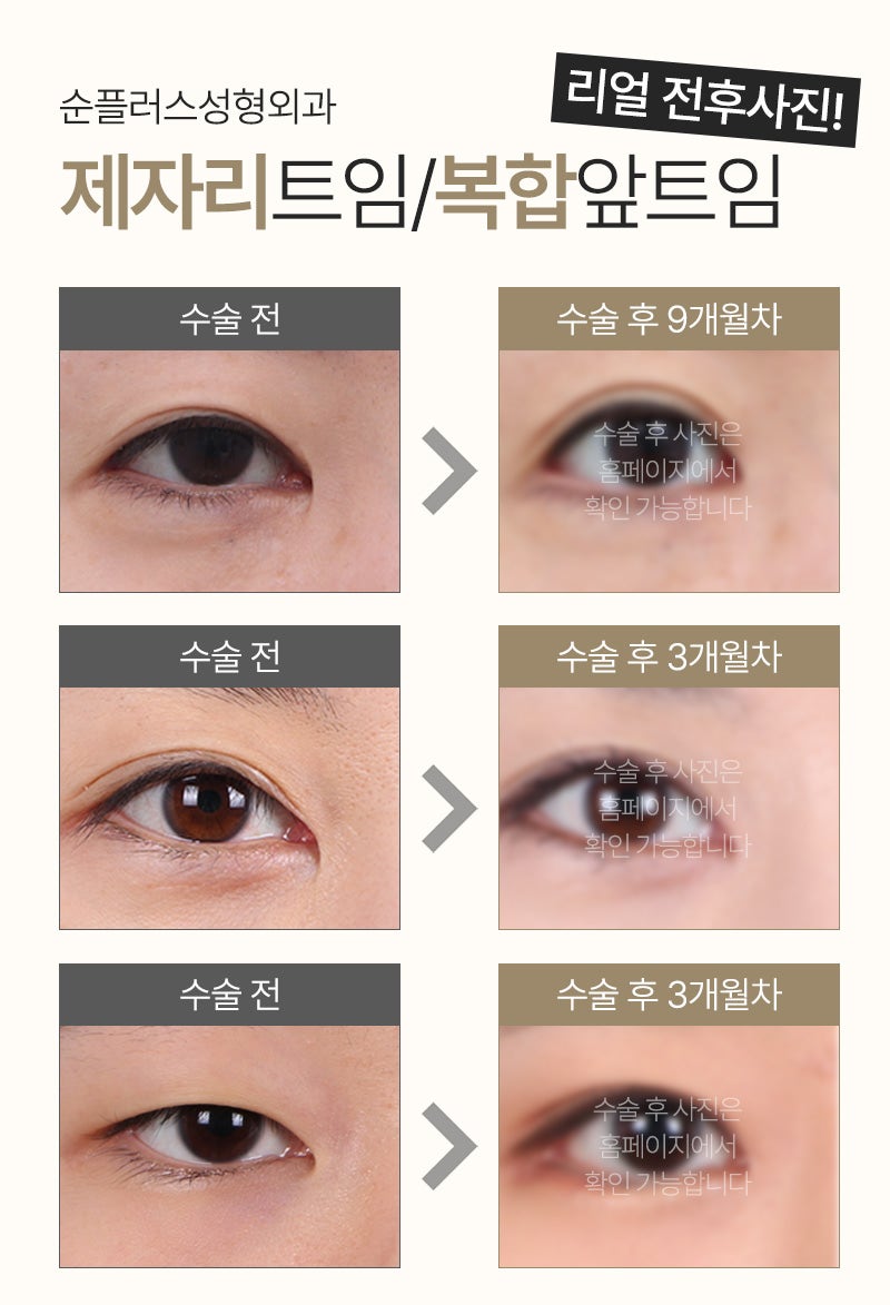 트임 부작용 개선과 몽고주름 제거로 눈매를 부드럽게 [앞트임-제자리트임] 관련 이미지 5