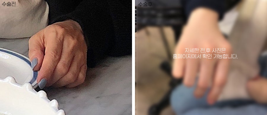 A lively effect for dry, wrinkled backs of the hands with fat grafting image 6