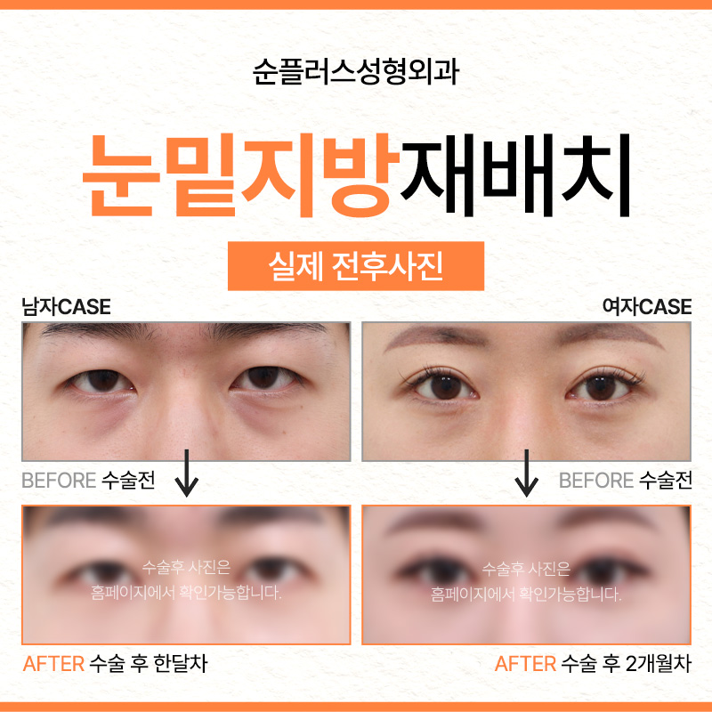 Sinsea Station Under-Eye Fat Repositioning Clinic: Not All the Same Approach image 5