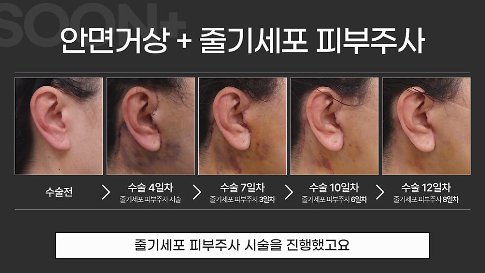 안면거상시 줄기세포주사를 병행하면 어떤 효과를 얻을까 관련 이미지 5