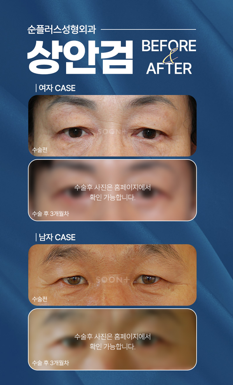 Blepharoptosis Surgery: Considering Both Aesthetics and Function image 5