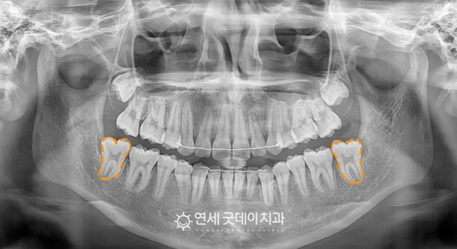 매복치아 견인교정 (feat. 구강외과 전문의 협진) 관련 이미지 15