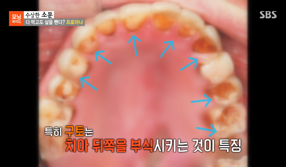 김보나원장님, 모닝와이드 7435회 &lsquo;다 먹고도 살을 뺀다, 프로아나&rsquo; 편 치과 자문의 출연 관련 이미지 7