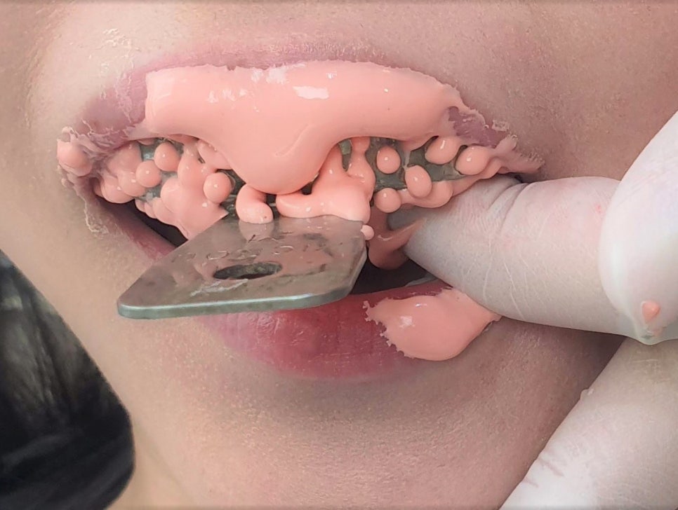 아이테로(iTero) 구강스캐너로 교정전후 시뮬레이션 결과를 확인하실 수 있습니다. 관련 이미지 2