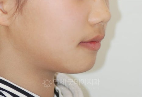 돌출입 무턱 치아교정 (15세 중학생) 관련 이미지 6