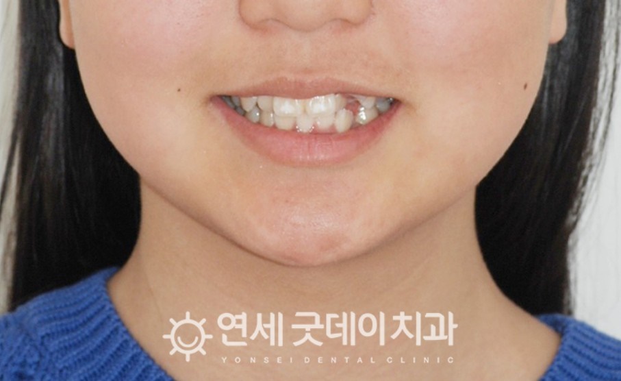 매복치아 견인교정 (feat. 구강외과 전문의 협진) 관련 이미지 1