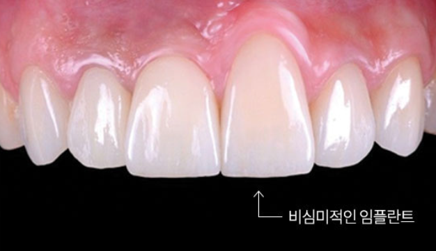 연세굿데이치과, 임플란트 권위자 박정철 교수님 초빙소식 :) 관련 이미지 3