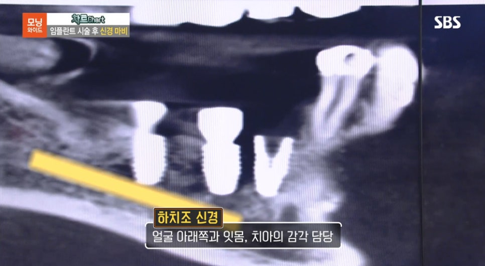 [2018.08.23] SBS모닝와이드 - 수서 연세굿데이 최세경 원장님 방송캡쳐 관련 이미지 7