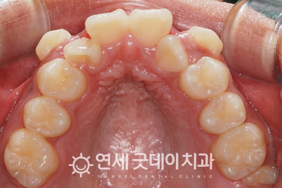 매복치아 견인교정 (feat. 구강외과 전문의 협진) 관련 이미지 2