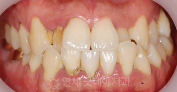 치과 잇몸치료 비용? 엠도게인 잇몸재생 사례 관련 이미지 2