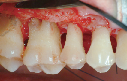 치과 잇몸치료 비용? 엠도게인 잇몸재생 사례 관련 이미지 8