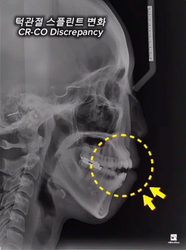Yonsei Goodday Dental Clinic: Orthodontic Treatment Considering CO-CR Discrepancy image 5