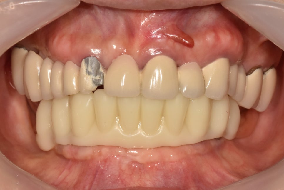 틀니 대안, 올온엑스(All-on-X) 시스템 도입 안내 관련 이미지 2