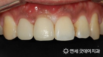 올 해 7월부터 65세 이상 어르신 틀니, 임플란트 보험 적용 ( 2016년 7월 1일부터 ) 관련 이미지 5