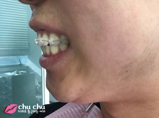 치아교정후기 2년간의 과정, 얼굴변화 (with 굿데이치과) 관련 이미지 2