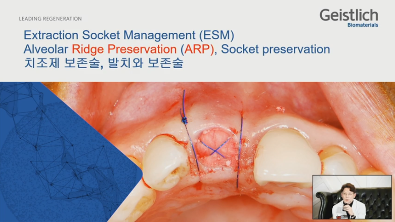 [Dr.정재욱] 치조제보존술(ARP) 유튜브 실시간 온라인강연 관련 이미지 10