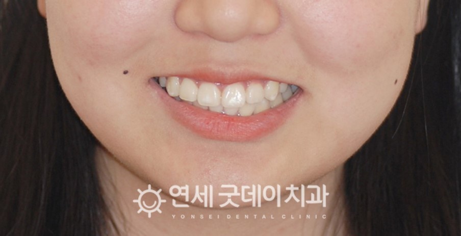 매복치아 견인교정 (feat. 구강외과 전문의 협진) 관련 이미지 11