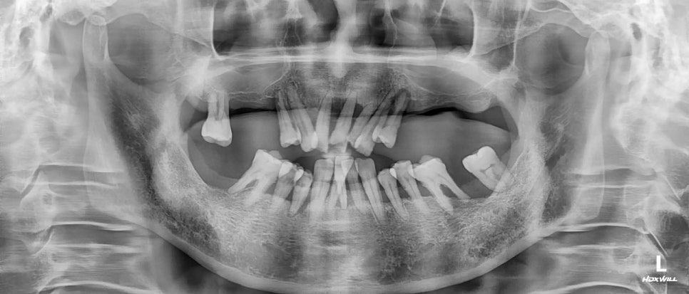 연세굿데이치과] 골이식재 종류와 중요성에 대해서 관련 이미지 2