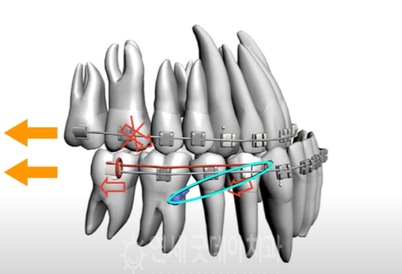 반대교합 교정 (30대 남성, 비발치) 관련 이미지 7