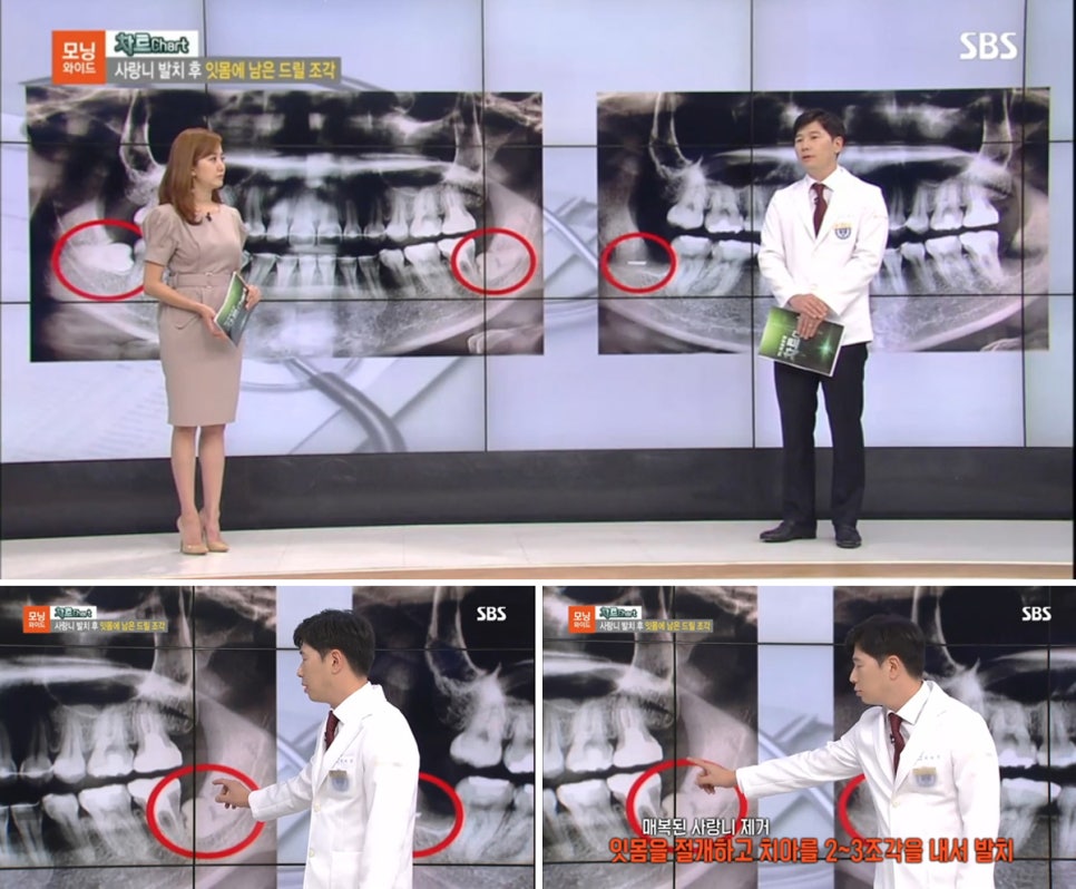 수서역 연세굿데이 치과 - 구강외과전문의 최세경 원장님 SBS모닝와이드 출연!! 관련 이미지 4