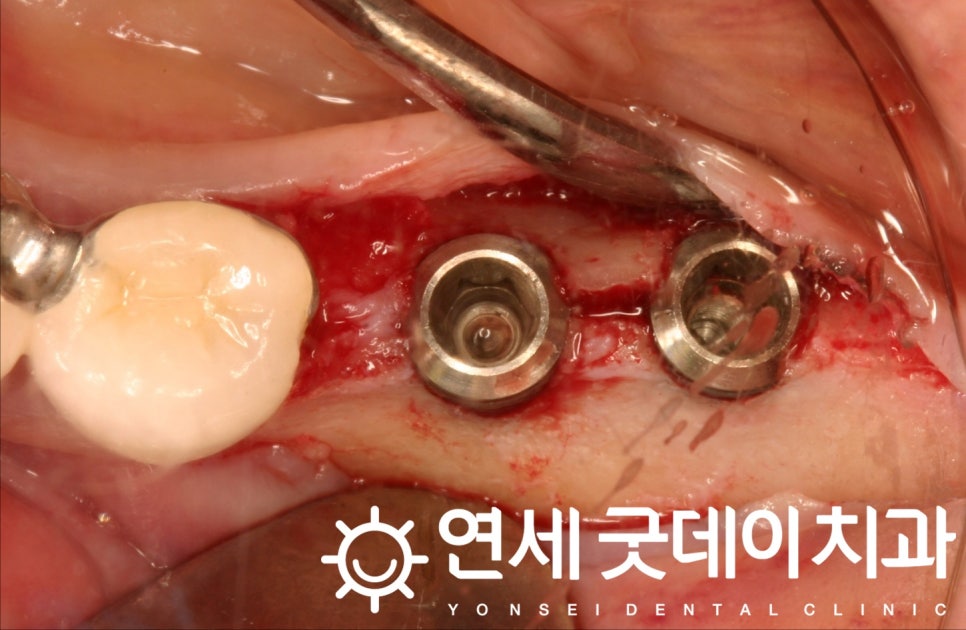 연세굿데이치과, 18년 장기보존 임플란트 증례발표 관련 이미지 5