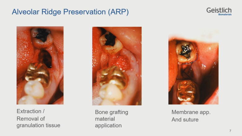 [Dr.정재욱] 치조제보존술(ARP) 유튜브 실시간 온라인강연 관련 이미지 12