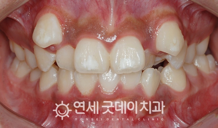 매복치아 견인교정 (feat. 구강외과 전문의 협진) 관련 이미지 12