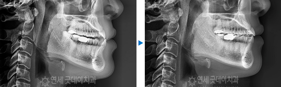 반대교합 교정 (30대 남성, 비발치) 관련 이미지 14