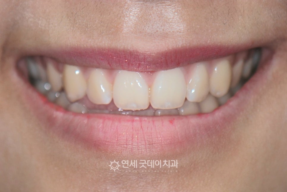 치아중심선 비대칭 교정 관련 이미지 4