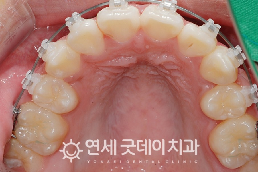 매복치아 견인교정 (feat. 구강외과 전문의 협진) 관련 이미지 10